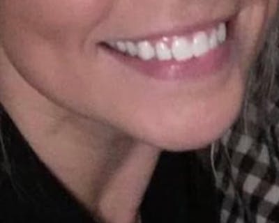 Lip Fillers Before & After Gallery - Patient 10380725 - Image 1