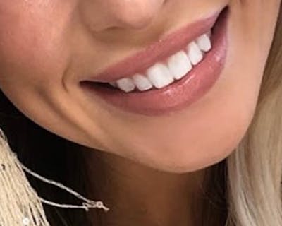 Lip Injection Before & After Gallery - Patient 10380725 - Image 2