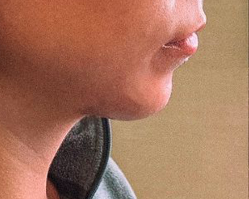 Chin Before & After Gallery - Patient 10380724 - Image 1