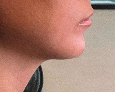 Chin Before & After Gallery - Patient 10380724 - Image 2