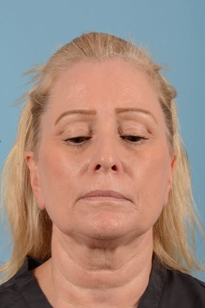 Facelift Before & After Gallery - Patient 44774608 - Image 1