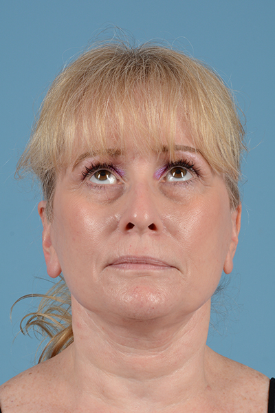Facelift Before & After Gallery - Patient 44774608 - Image 2