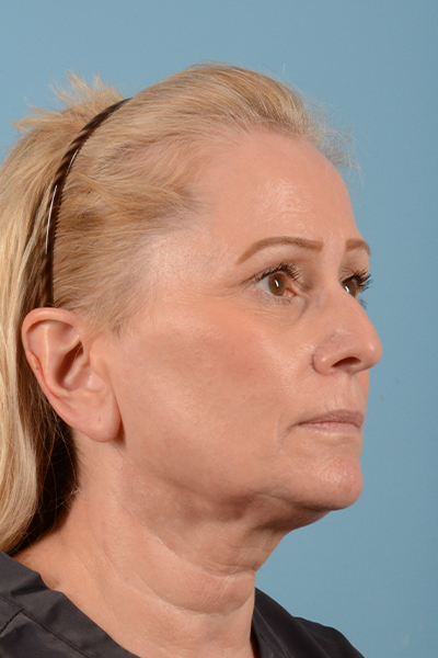 Facelift Before & After Gallery - Patient 44774608 - Image 3
