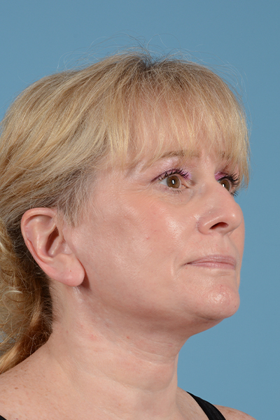 Facelift Before & After Gallery - Patient 44774608 - Image 4