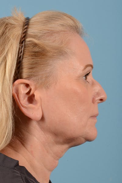 Facelift Before & After Gallery - Patient 44774608 - Image 5