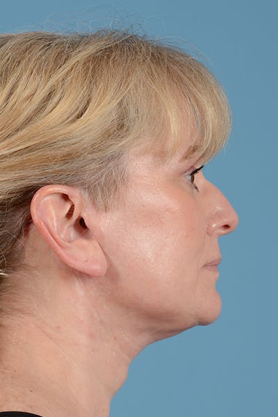 Facelift Before & After Gallery - Patient 44774608 - Image 6