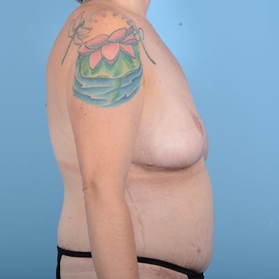 Breast Lift Before & After Gallery - Patient 52517603 - Image 6