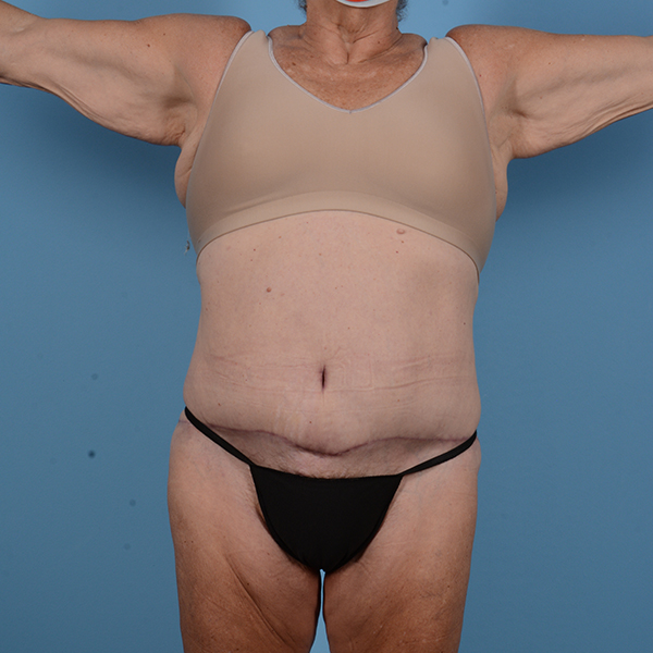 Panniculectomy Before & After Gallery - Patient 53263685 - Image 2