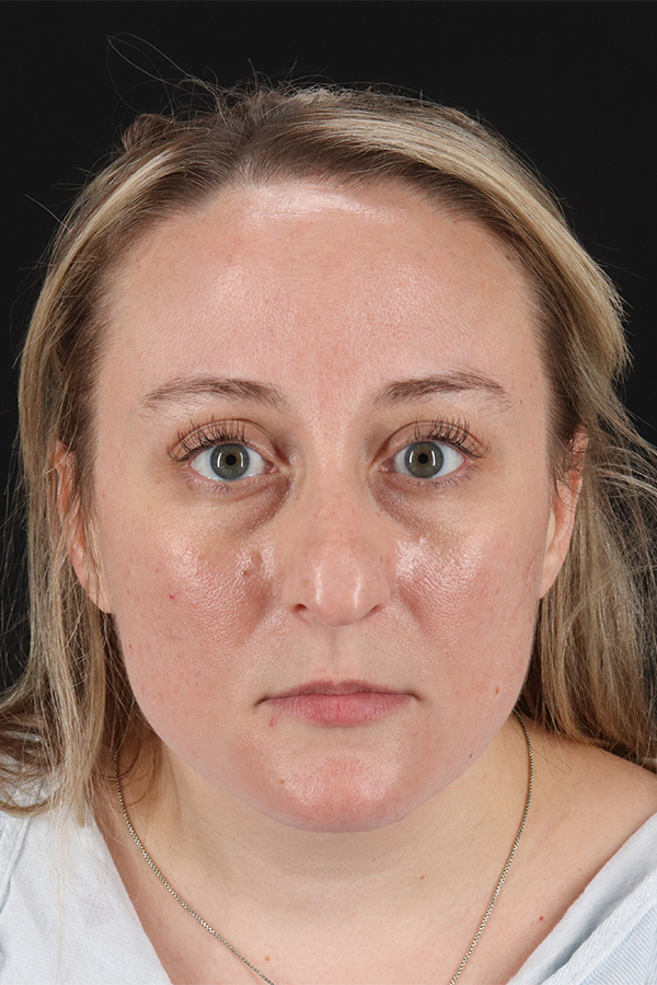 Rhinoplasty Before & After Gallery - Patient 106381232 - Image 1