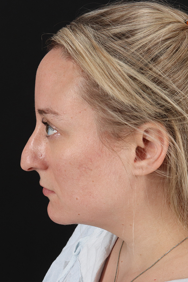 Rhinoplasty Before & After Gallery - Patient 106381232 - Image 3