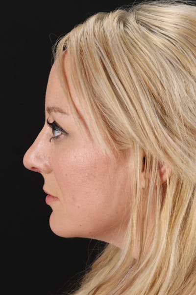 Rhinoplasty Before & After Gallery - Patient 106381232 - Image 6