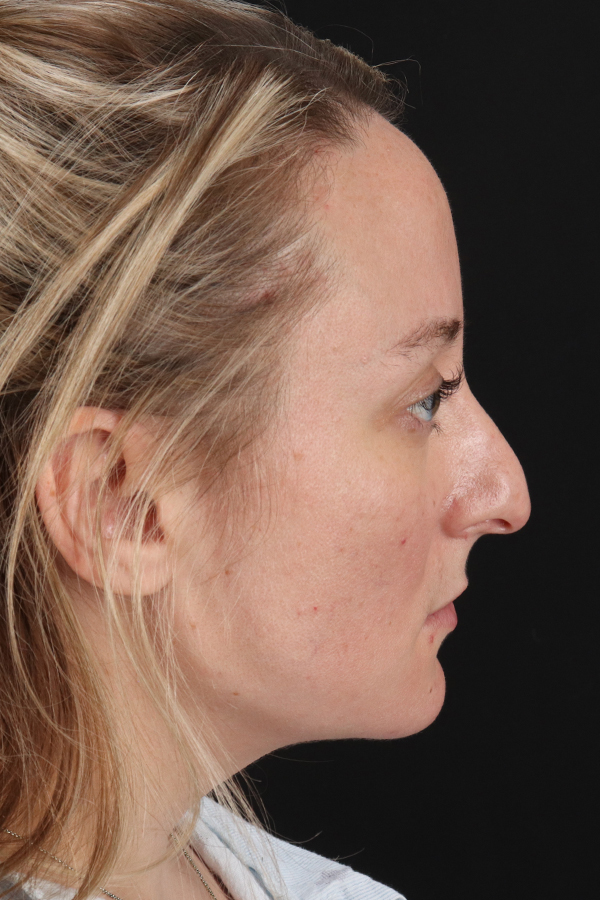 Rhinoplasty Before & After Gallery - Patient 106381232 - Image 1