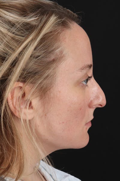 Rhinoplasty Before & After Gallery - Patient 106381232 - Image 5