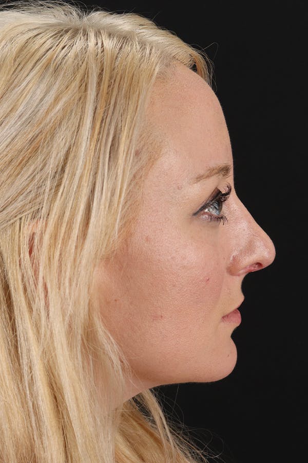 Rhinoplasty Before & After Gallery - Patient 106381232 - Image 2