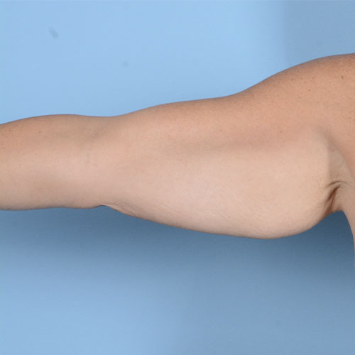 Armlift (Brachioplasty) Before & After Gallery - Patient 121839314 - Image 1