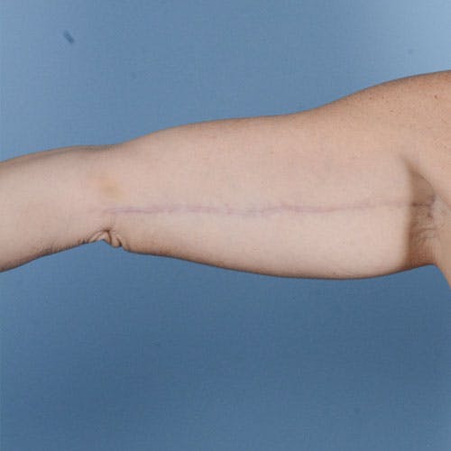 Armlift (Brachioplasty) Before & After Gallery - Patient 121839314 - Image 2