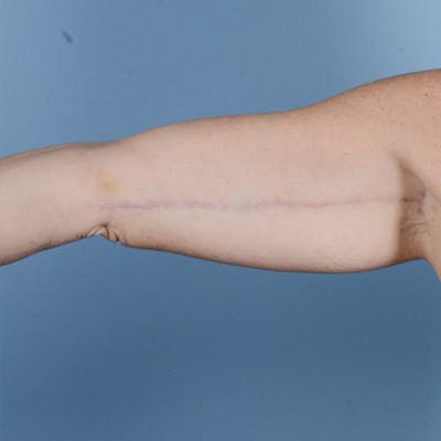 Armlift (Brachioplasty) Before & After Gallery - Patient 121839314 - Image 2
