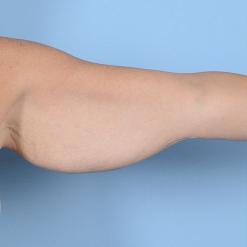 Armlift (Brachioplasty) Before & After Gallery - Patient 121839314 - Image 3
