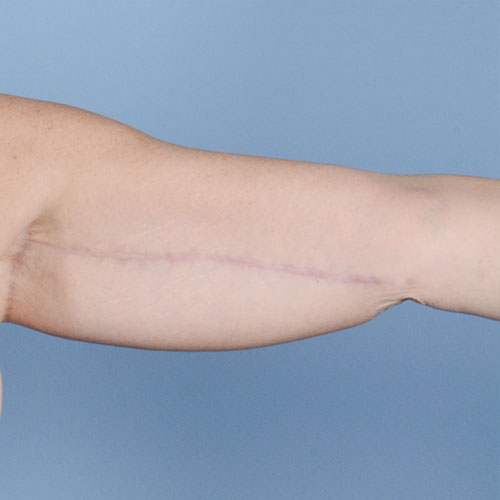 Armlift (Brachioplasty) Before & After Gallery - Patient 121839314 - Image 4