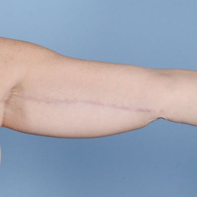 Armlift (Brachioplasty) Before & After Gallery - Patient 121839314 - Image 4