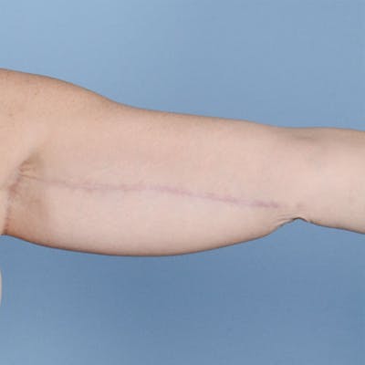 Brachioplasty Before & After Gallery - Patient 121839314 - Image 4