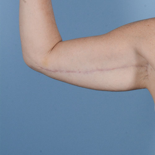 Armlift (Brachioplasty) Before & After Gallery - Patient 121839314 - Image 6