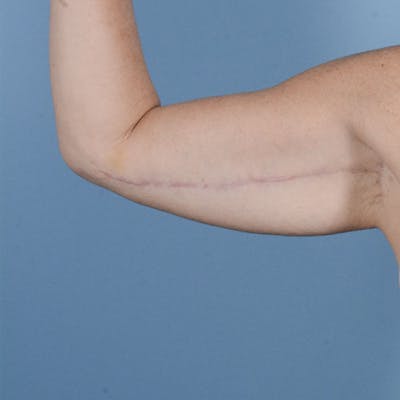 Armlift (Brachioplasty) Before & After Gallery - Patient 121839314 - Image 6