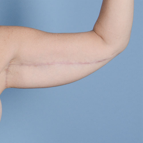 Armlift (Brachioplasty) Before & After Gallery - Patient 121839314 - Image 8