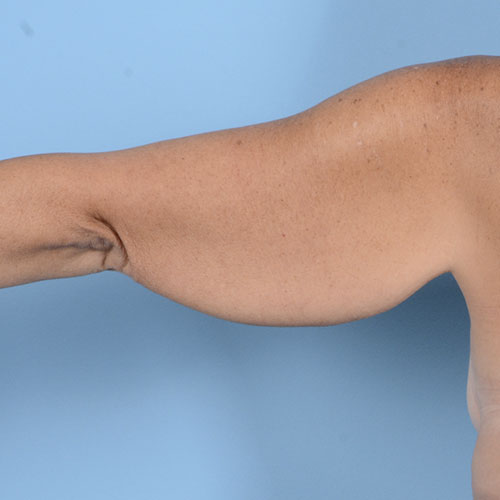 Armlift (Brachioplasty) Before & After Gallery - Patient 121839314 - Image 9