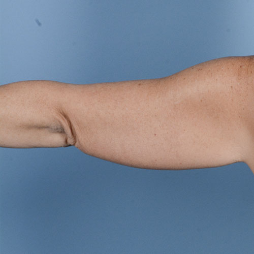 Armlift (Brachioplasty) Before & After Gallery - Patient 121839314 - Image 10