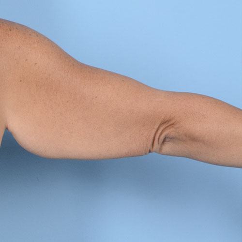 Armlift (Brachioplasty) Before & After Gallery - Patient 121839314 - Image 11