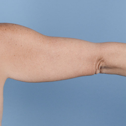 Armlift (Brachioplasty) Before & After Gallery - Patient 121839314 - Image 12