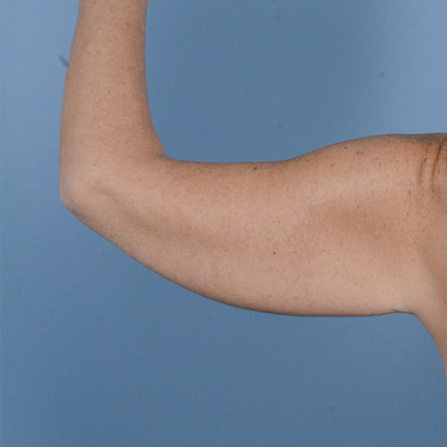 Armlift (Brachioplasty) Before & After Gallery - Patient 121839314 - Image 14