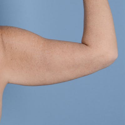Armlift (Brachioplasty) Before & After Gallery - Patient 121839314 - Image 16