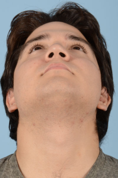 Rhinoplasty Before & After Gallery - Patient 121839335 - Image 3