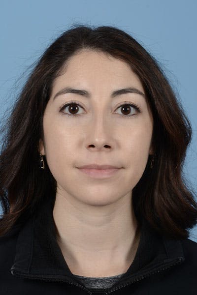 Rhinoplasty Before & After Gallery - Patient 121839336 - Image 1