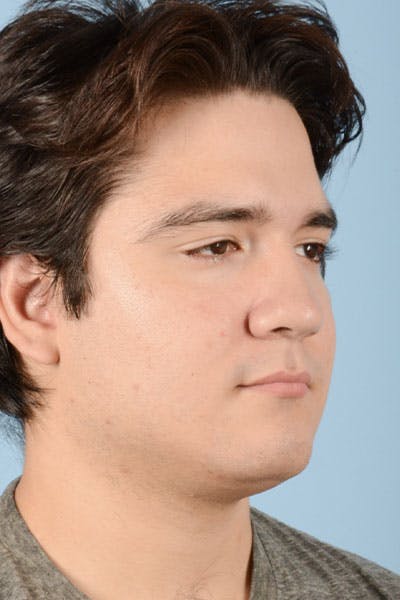Rhinoplasty Before & After Gallery - Patient 121839335 - Image 5