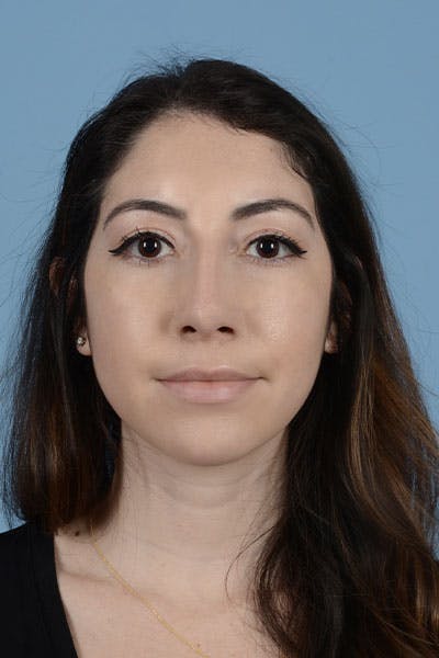 Rhinoplasty Before & After Gallery - Patient 121839336 - Image 2