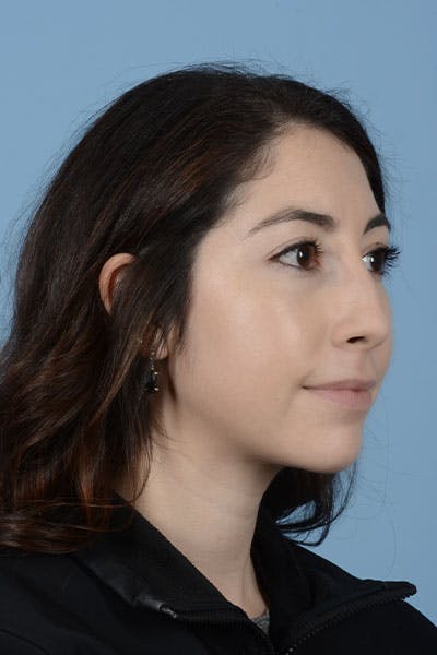 Rhinoplasty Before & After Gallery - Patient 121839336 - Image 3