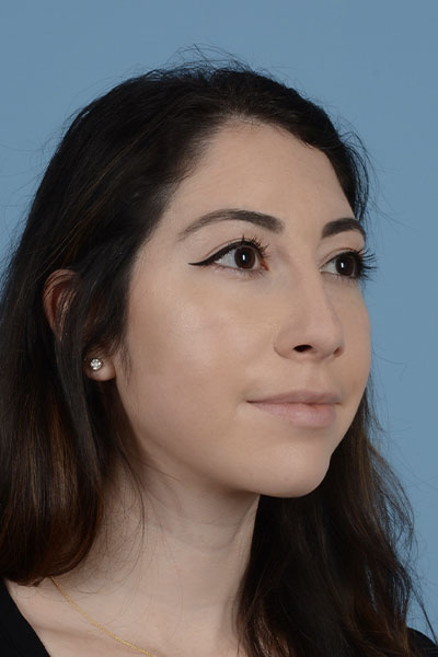 Rhinoplasty Before & After Gallery - Patient 121839336 - Image 4