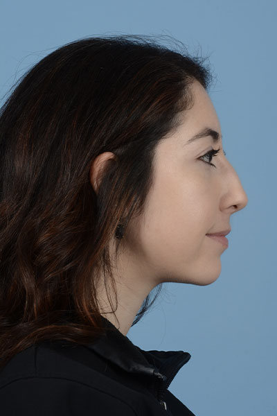 Rhinoplasty Before & After Gallery - Patient 121839336 - Image 5