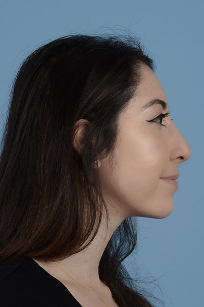 Rhinoplasty Before & After Gallery - Patient 121839336 - Image 6
