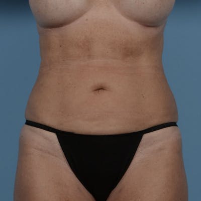 Liposuction Before & After Gallery - Patient 121839516 - Image 2