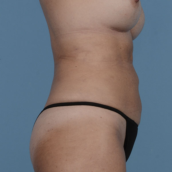 Liposuction Before & After Gallery - Patient 121839516 - Image 6