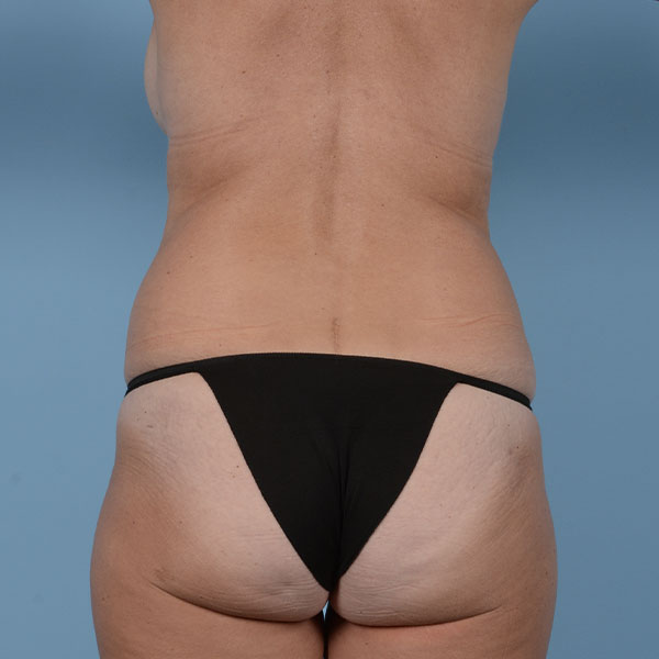 Liposuction Before & After Gallery - Patient 121839516 - Image 11