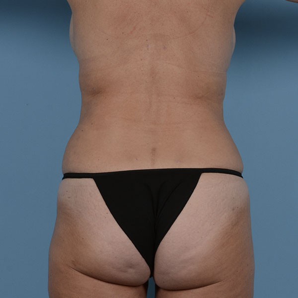 Liposuction Before & After Gallery - Patient 121839516 - Image 12