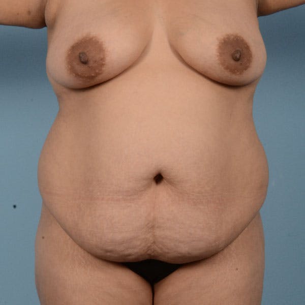 Liposuction Before & After Gallery - Patient 121839517 - Image 1
