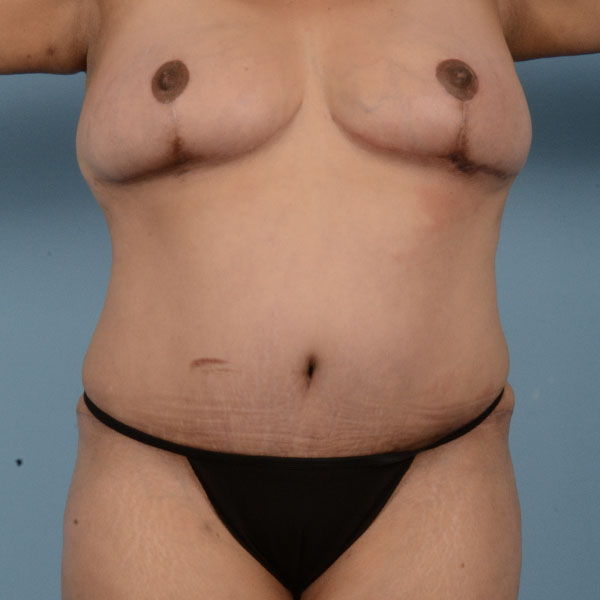 Liposuction Before & After Gallery - Patient 121839517 - Image 2