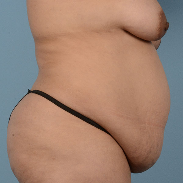 Liposuction Before & After Gallery - Patient 121839517 - Image 5