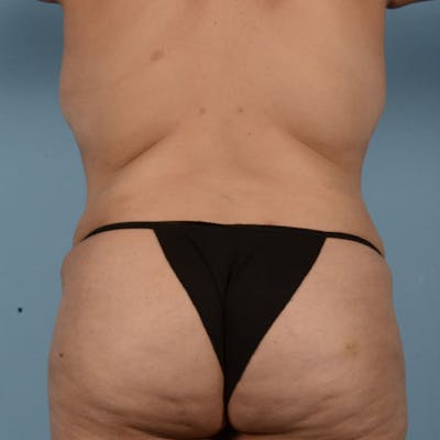 Liposuction Before & After Gallery - Patient 121839517 - Image 10